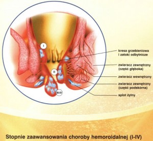 Operacje hemoroidów