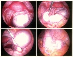 Endometrioza