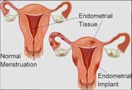 Endometrioza