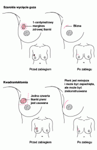 Operacje oszczędzające