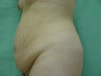 Plastyka brzucha