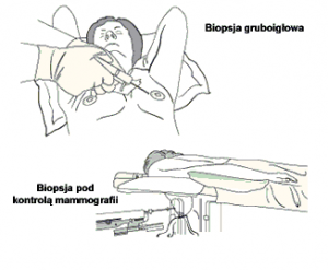 biopsja